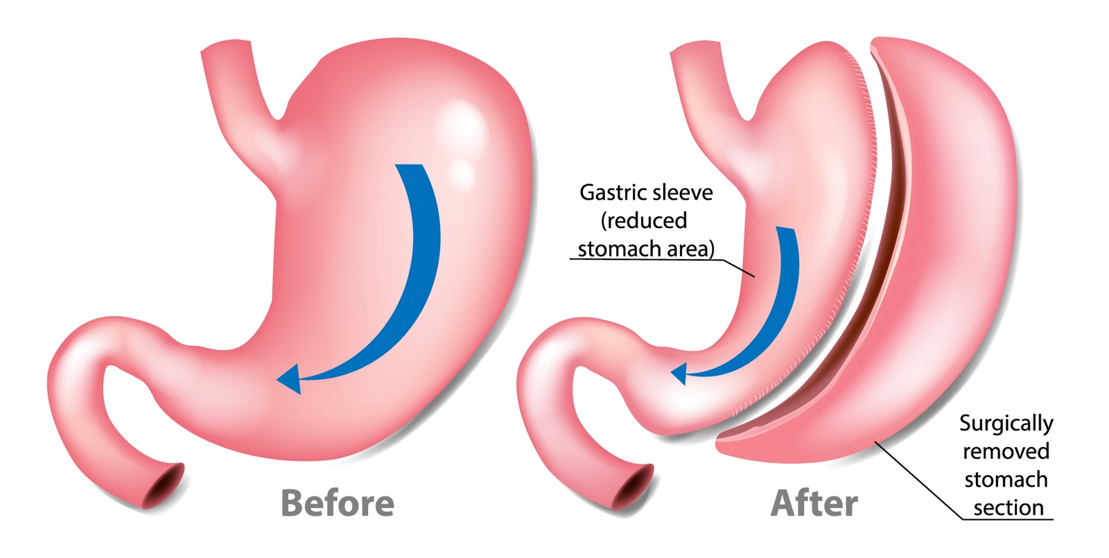gastric sleeve surgeon